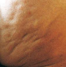 Cellulitis5 Blog - Natuurlijk gezond - Santura